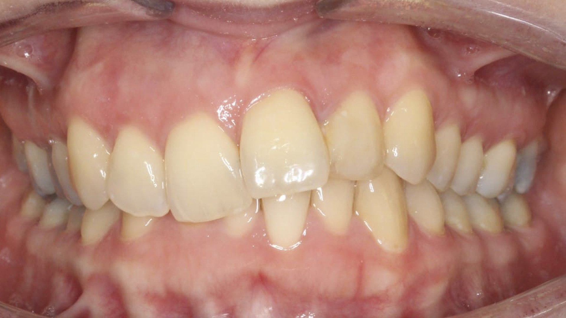 قبل از درمانهای ارتودنسی